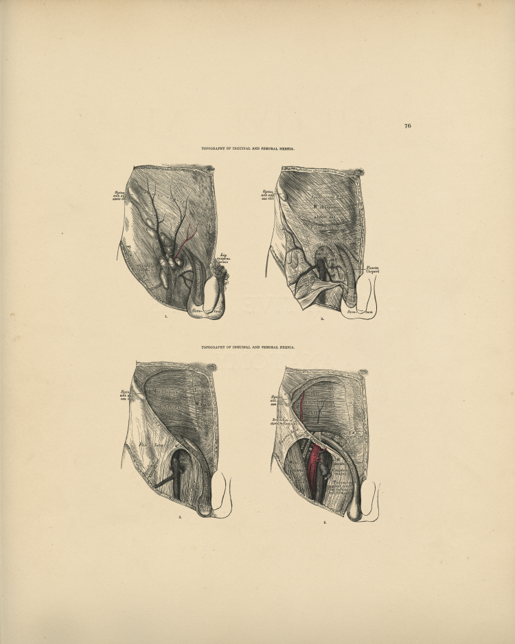 Hernia Anatomy Print