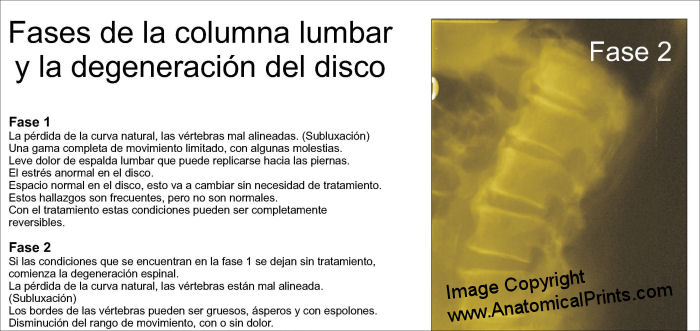 phases-of-lumbar-spinal-degeneration-chart-spanish