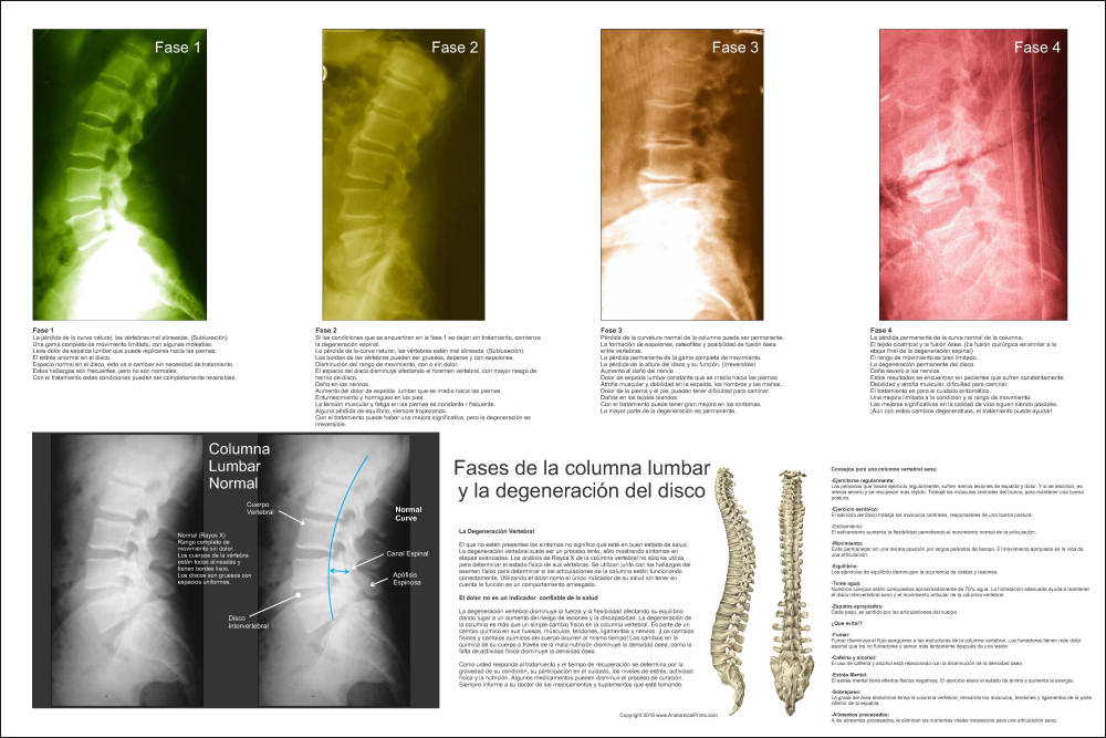 Phases of Lumbar Spinal Degeneration Chart Spanish